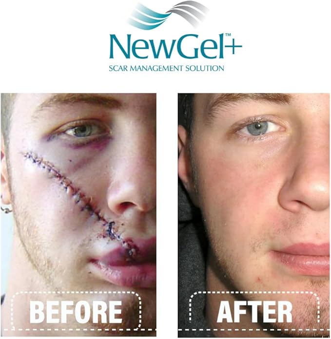 NewGel+E Advanced Silicone Scar Treatment Gel (1 oz)