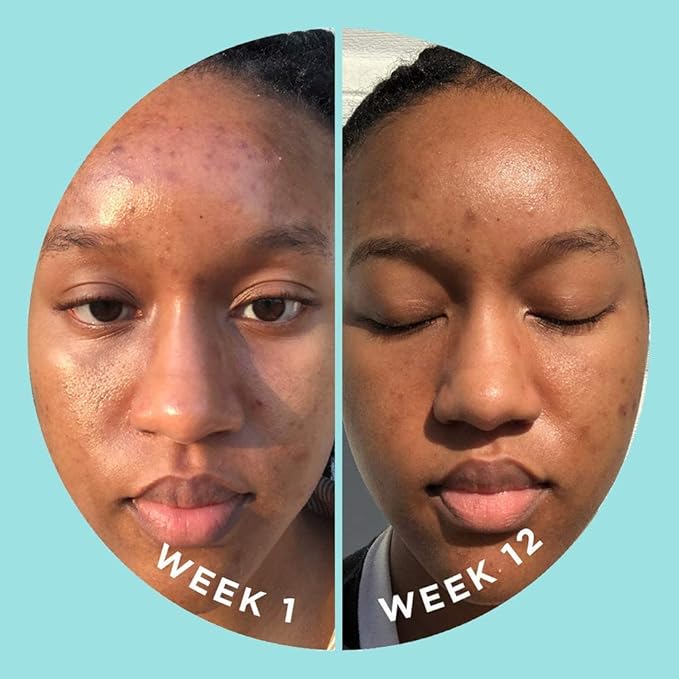 ZitSticka Vitamin Acne Supplement for Cystic Acne w/ 30 Natural Caps for Women and Men, Supplements for Hormonal Support, Skin Clarity, Dark Spots - Dermatologist Tested (Blur Potion™)