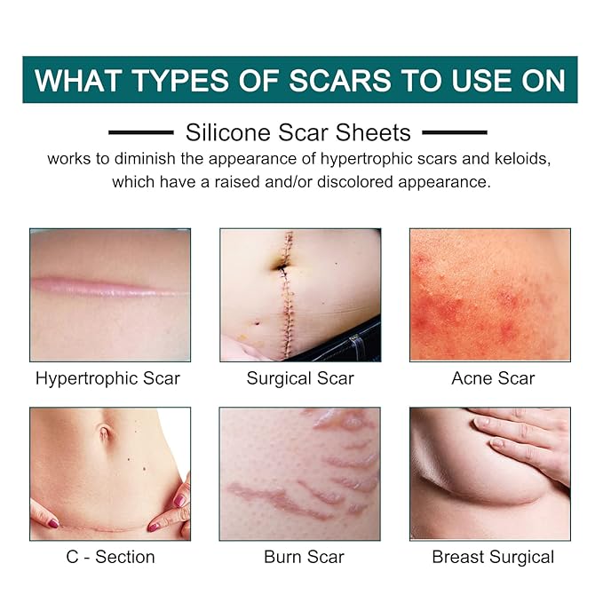 Silicone Scar Sheets (1.6” x 120” Roll-3M), Silicone