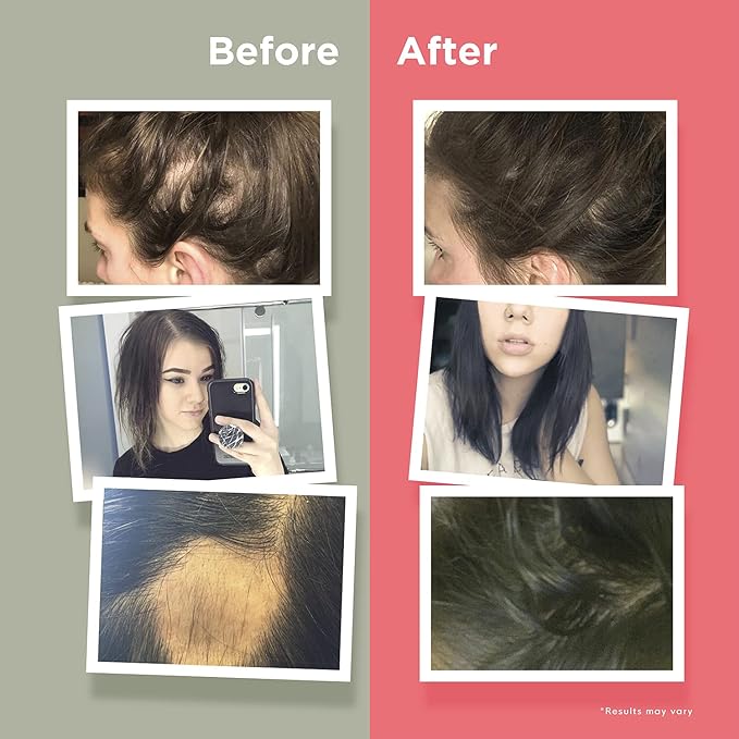Naturenetics HairAnew Hair Growth Vitamins for Women & Men - Hair Vitamins For Faster Hair Growth & Thickness - Part of Proceeds go to Hair Loss Charity - Vegan Hair Supplement For Hair Skin Nails (1)
