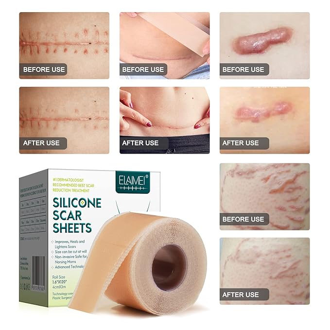Silicone Scar Sheets (1.6” x 120” Roll-3M), Silicone