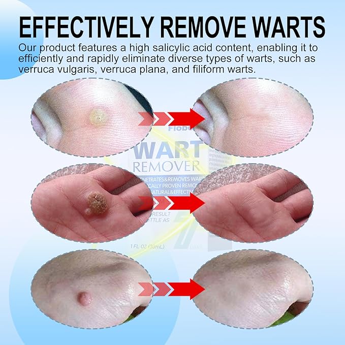 at-Home Skin Tag Remover Kit 17% Salicylic 3333