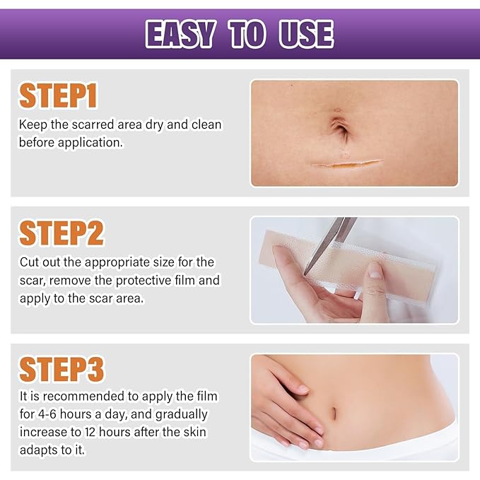 Silicone Scar Sheets,Silicone Scar Tape,Scar Tape Scars(1.6"X 59" 59" Roll-1.5M) Roll-1.5M) Keloid