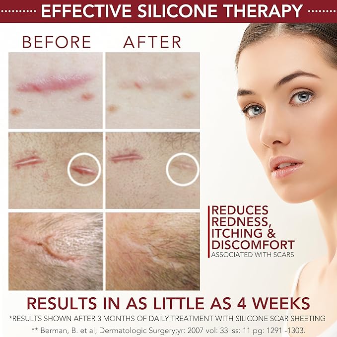 Physician Formulated Silicone Scar Gel Semi-Solid Sheeting