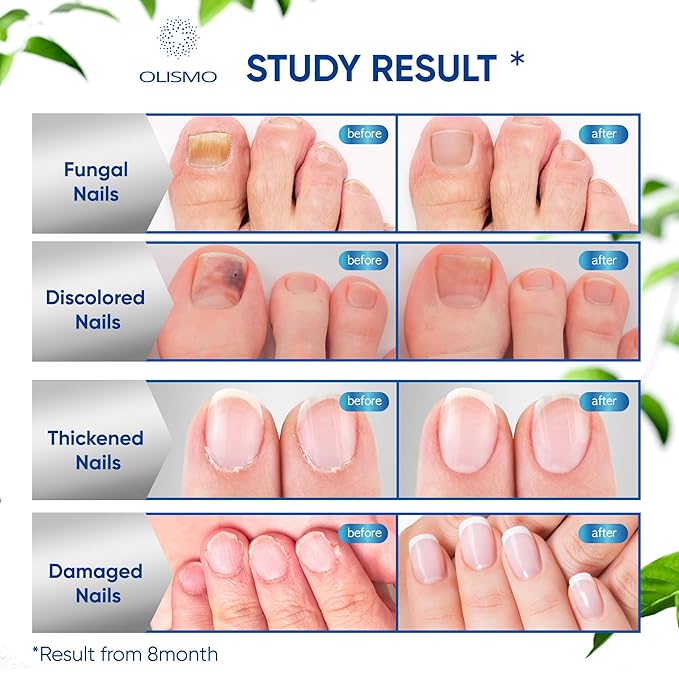 Toenail Fungus Treatment, Nail Fungus Treatment 30ML (1 (1 FLOZ)