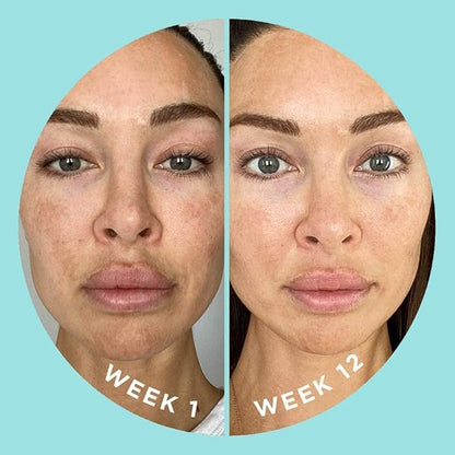 ZitSticka Vitamin Acne Supplement for Cystic Acne w/ 30 Natural Caps for Women and Men, Supplements for Hormonal Support, Skin Clarity, Dark Spots - Dermatologist Tested (Blur Potion™)