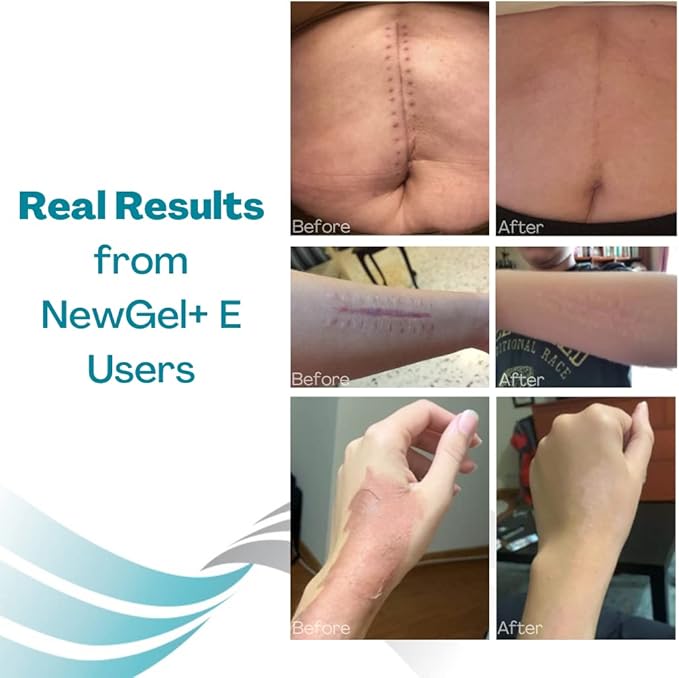 NewGel+E Advanced Silicone Scar Treatment Gel (1 oz)