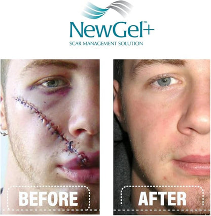 NewGel+E Advanced Silicone Scar Treatment Gel (1 oz)