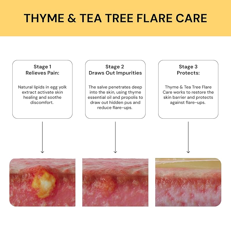 Thyme & Tea Tree Flare Care (1oz)