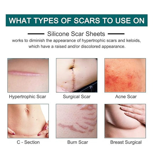 Silicone Scar Sheets (1.6” x 120” Roll-3M), Silicone