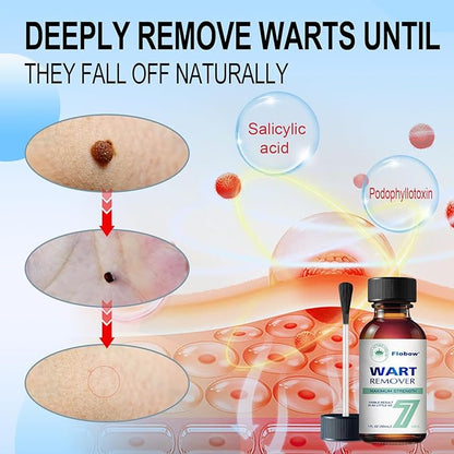at-Home Skin Tag Remover Kit 17% Salicylic 3333
