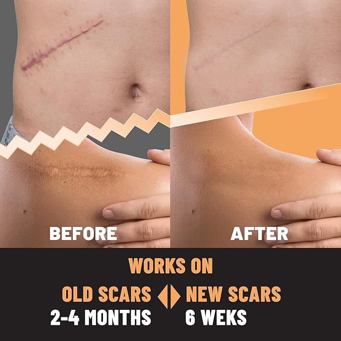 Silicone Scar Patches – Silicone Gel 5 Sheets
