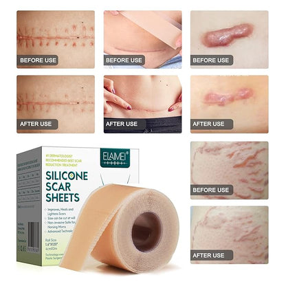 Silicone Scar Sheets (1.6” x 120” Roll-3M), Silicone