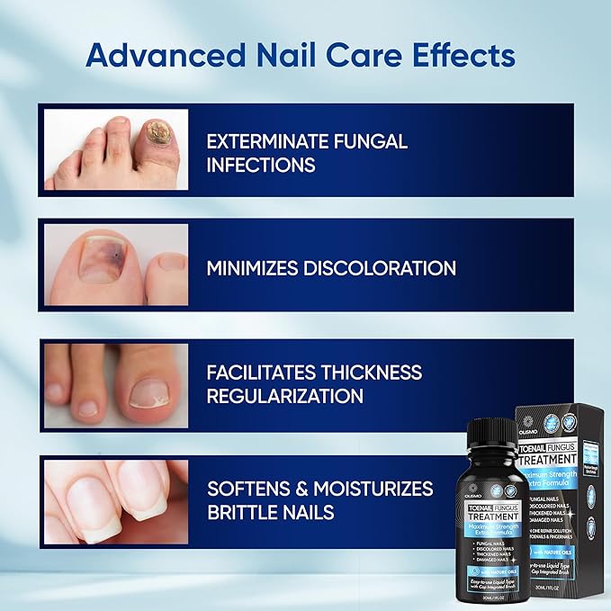 Toenail Fungus Treatment, Nail Fungus Treatment 30ML (1 (1 FLOZ)