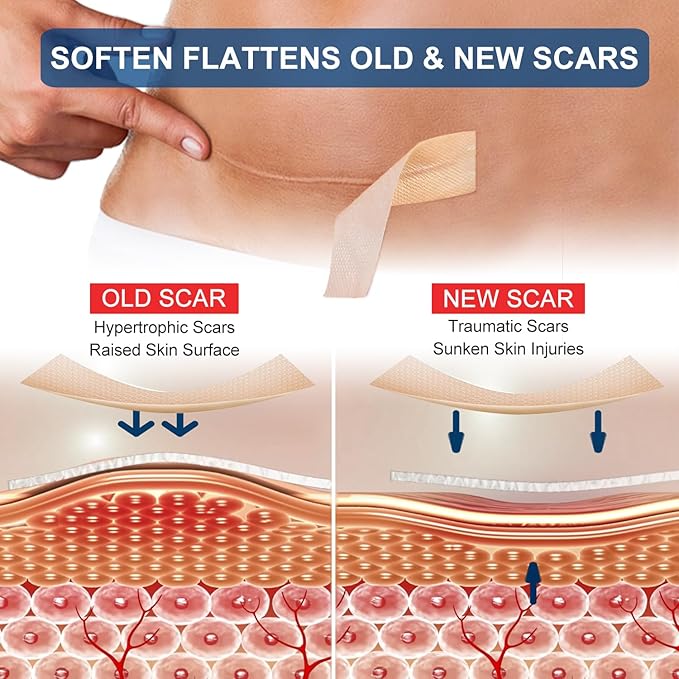 Silicone Scar Sheets (1.6” x 120” Roll-3M), Silicone