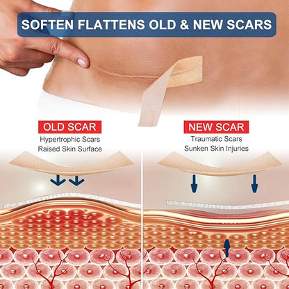 Silicone Scar Sheets (1.6” x 120” Roll-3M), Silicone
