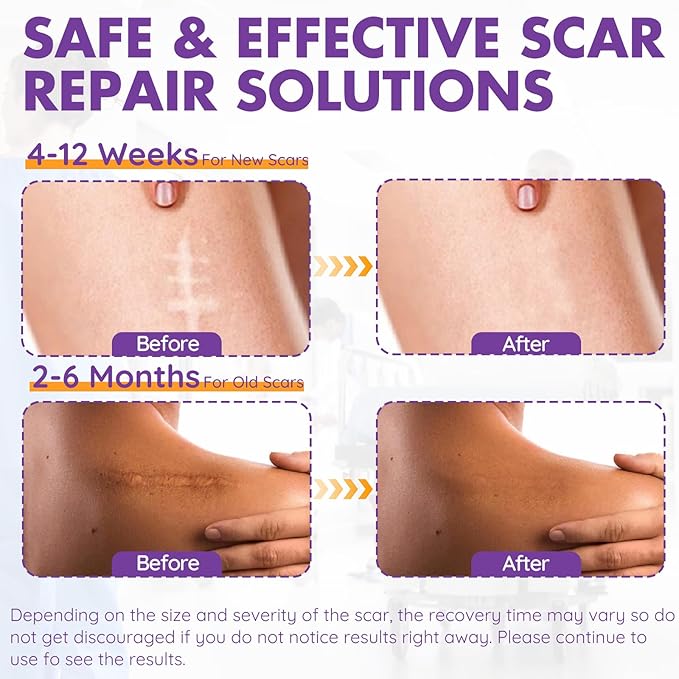 Silicone Scar Sheets, Silicone Scar Tape(1.6"x 79" Roll-2M), Roll-2M), Reusable