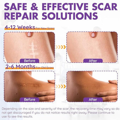 Silicone Scar Sheets, Silicone Scar Tape(1.6"x 79" Roll-2M), Roll-2M), Reusable