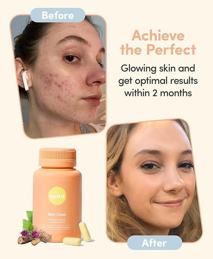 Ovira Skin Clear with ZINCBRIGHT - 60 Capsules for Clear and Glowing Skin | Rosacea & Hormonal Acne Treatment | Support Collagen Production | Acne Supplements for Women & Men - Pack of 2