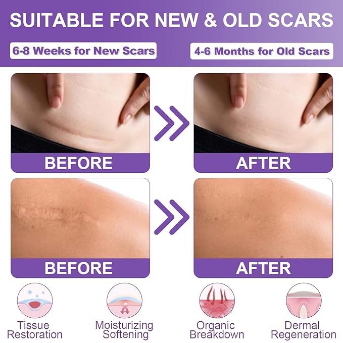 Silicone Scar Sheets, Medical Grade Silicone (1.6" x 120"), Professional
