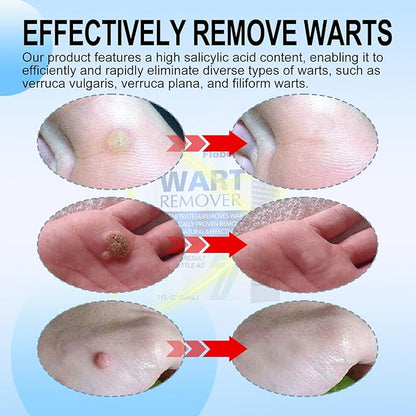 at-Home Skin Tag Remover Kit 17% Salicylic 3333