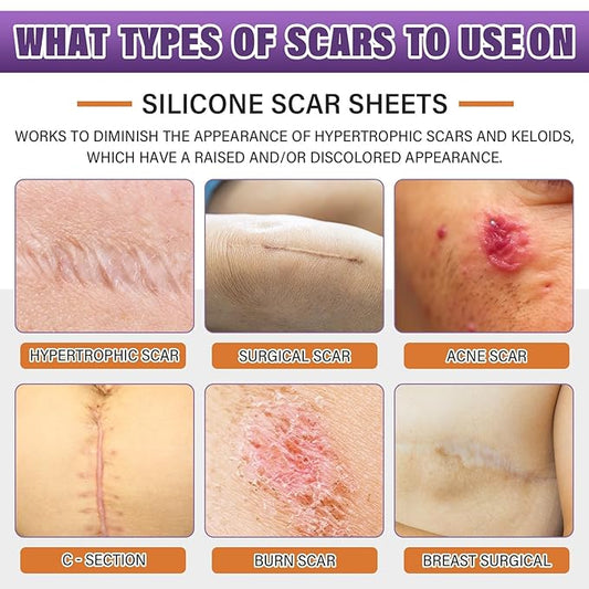 Silicone Scar Sheets,Silicone Scar Tape,Scar Tape Scars(1.6"X 59" 59" Roll-1.5M) Roll-1.5M) Keloid