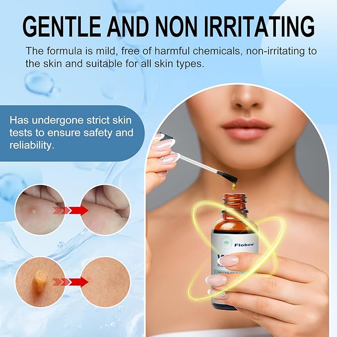 at-Home Skin Tag Remover Kit 17% Salicylic 3333