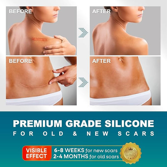 Silicone Scar Sheets, Silicone Scar Tape(1.6"x 120" Roll-300CM), Roll-300CM), Silicone