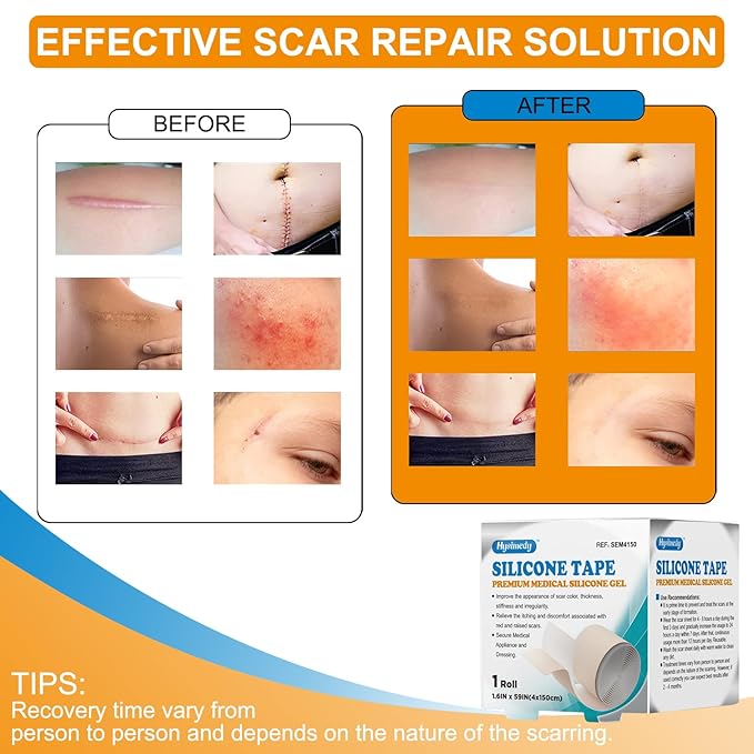 Silicone Scar Sheets Silicone Gel Scar (1.6" x 59"-1.5M) -