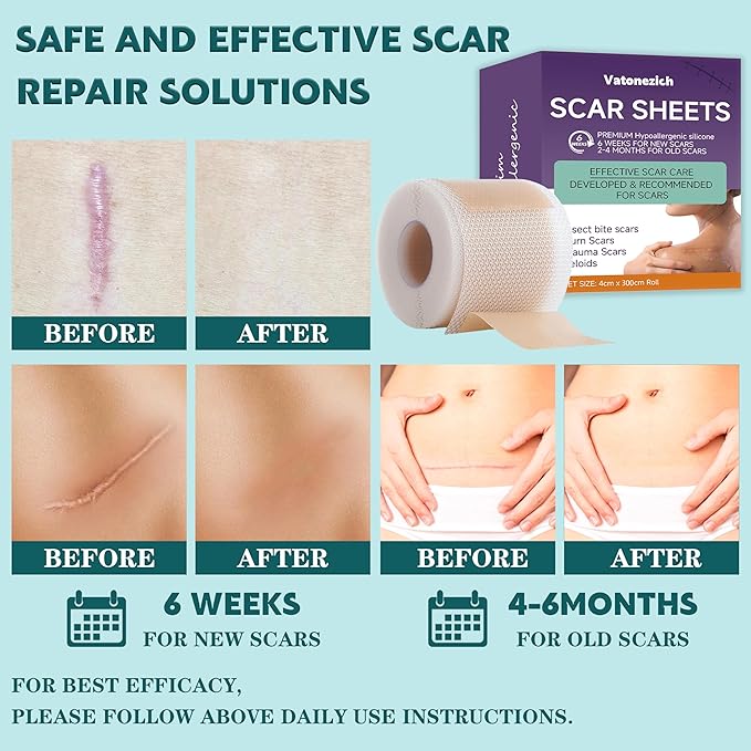 Silicone Scar Sheets,(1.6" X 120" Roll- 3M) Silicone