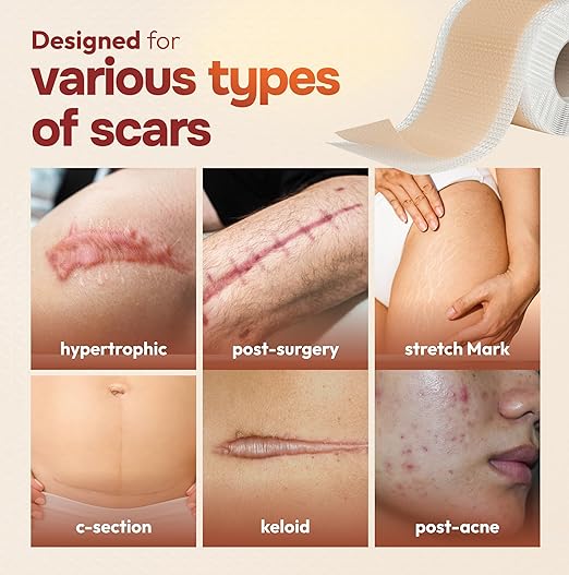 10 Pack Silicone Sheets for Scars, (6” x 1.6”)