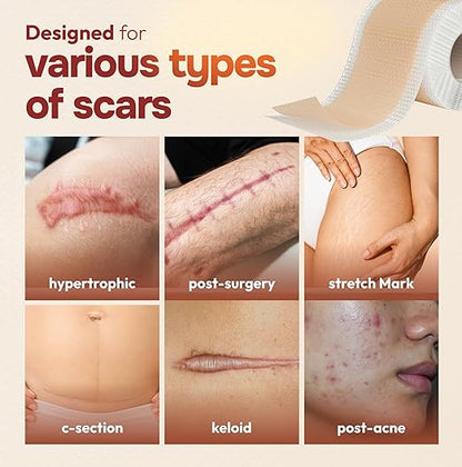 10 Pack Silicone Sheets for Scars, (6” x 1.6”)