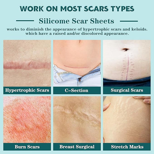 Silicone Scar Sheets,(1.6" X 60" Roll-1.5M)