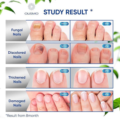 Toenail Fungus Treatment, Nail Fungus Treatment 30ML (1 (1 FLOZ)