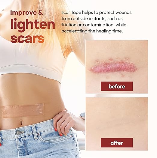 10 Pack Silicone Sheets for Scars, (6” x 1.6”)